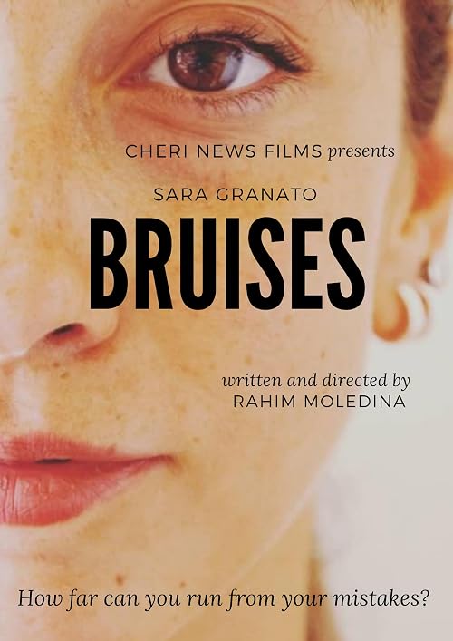 Bruises