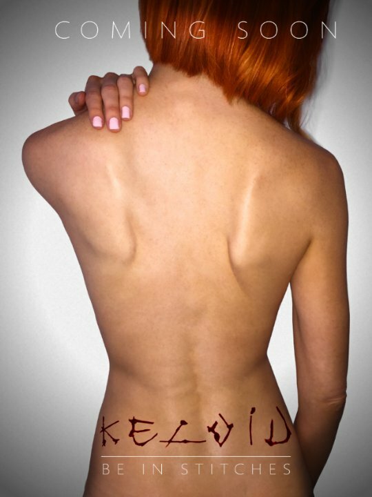 Keloid